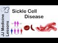 Sickle Cell Disease | Pathophysiology, Symptoms and Treatment