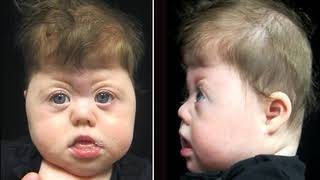Saethre Chotzen Syndrome ; Definition, Causes, Symptoms, Diagnosis, Treatment