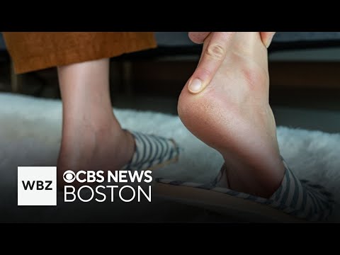 How to treat the common cause of heel pain