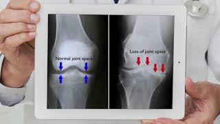 علاج #خشونة_الركبتين بدون تدخل جراحي أو تخدير كلي | أ.د. تامر عمر السعيد