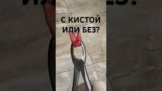 С КИСТОЙ ИЛИ БЕЗ?😨😱 #шортс #медицина