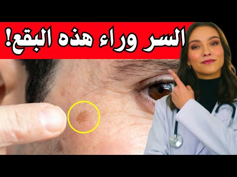 ما تكشفه البقع الداكنة على بشرتك بعد سن الخمسين