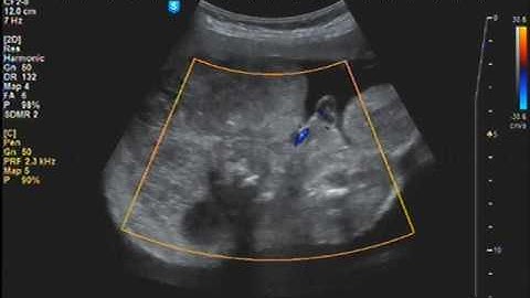 Twin reversed arterial perfusion _ TRAPS