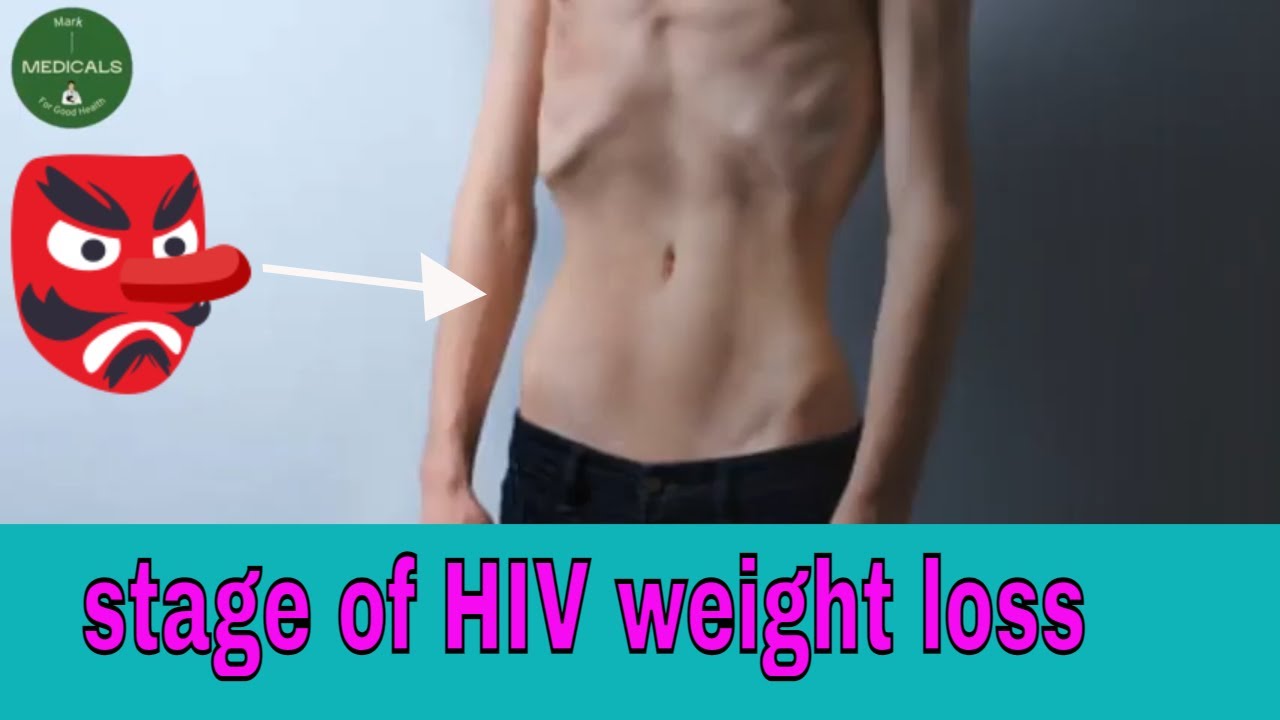 At What Stage Of HIV Does Weight Loss Occur YouTube where-does-hiv-rash-appear-skin-conditions-associated-with-hiv