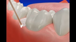 How Gum Disease Treatment Laser works