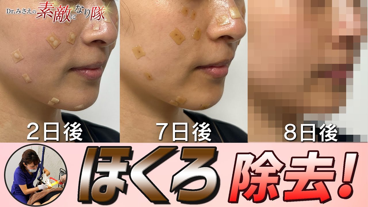 【ほくろ除去】炭酸ガスレーザー施術後の変化を大公開！施術後3日で真っ赤に？