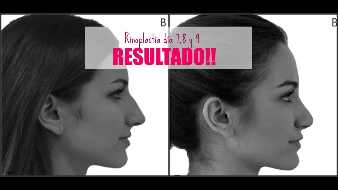 Mi rinoplastia día 7, 8 y 9 || RESULTADO!