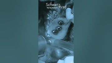 Posterior maxilla defect repair via sinus elevation and Autologous Onlay Bone Graft