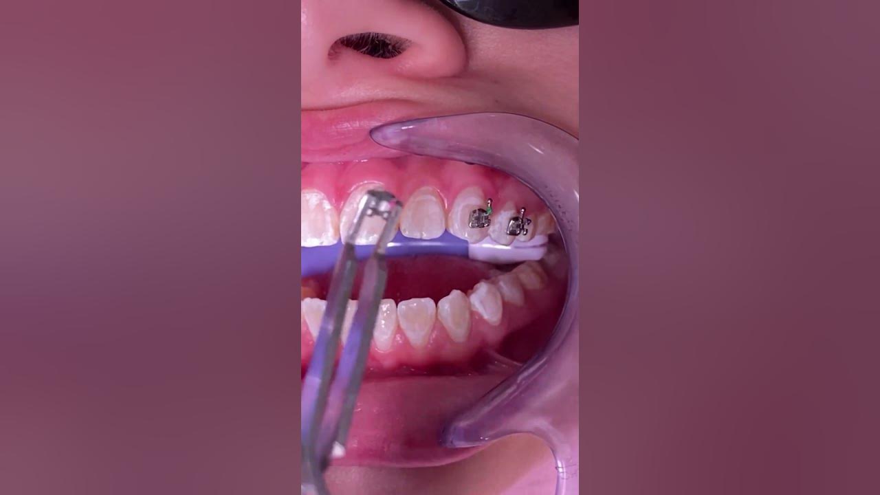 Braces Molar Brackets What if I don't get Molar Bands Tooth Time Family Dentistry New