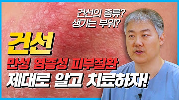 건선은 만성 염증성 질환, 발병 원인부터 치료방법까지(피부과, 한의원)