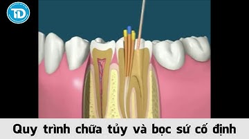 Chữa tủy răng và bọc răng sứ như thế nào?