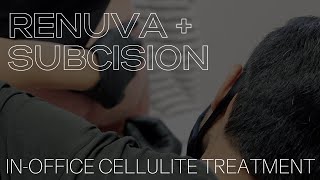 In Office Cellulite Treatment