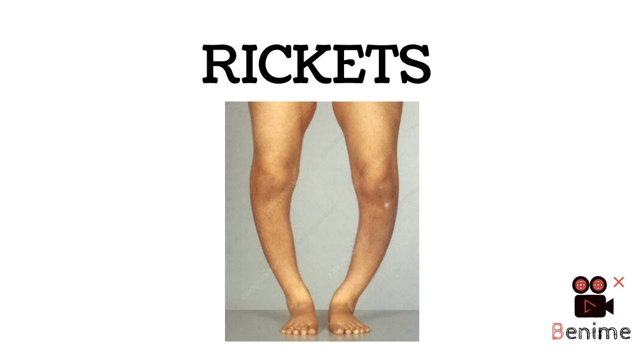 Rickets | Orthopaedics | MBBS| Neetpg | #rickets #orthopaedics # ...
