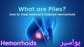 Piles or Hemorrhoids/ بواسیر / Diagnosis and treatment