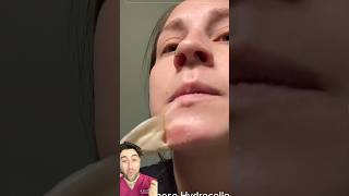 The BEST RESULT EVER from a hydrocolloid patch?