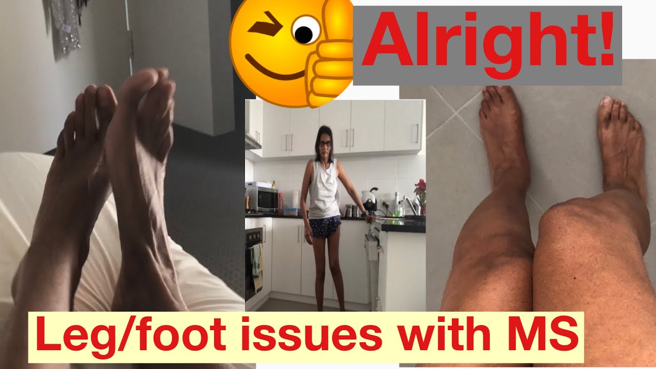 Leg spasms/cramps/restless leg/ twitching All MS leg symptoms I have