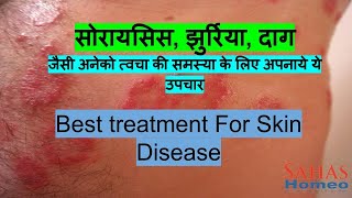 Skin Disease like  Psoriasis, Fungal, Eczema fully treated -|