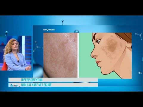 Video: Si i largon dermatologu njollat e zeza?