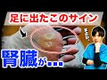 絶対に見逃さないで！将来腎臓が悪くなる糖尿病の危険なサイン５選。血糖値上昇を防ぐ神食材もお伝えします。