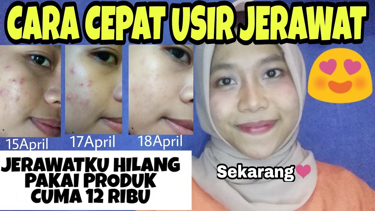 CARA MENGHILANGKAN JERAWAT dengan CEPAT dan BEKASNYA by ...