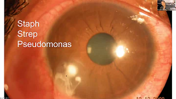 Come capire se la cornea è graffiata?