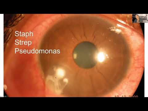 Lecture: Corneal Disease