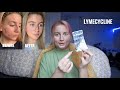 my acne journey | lymecycline