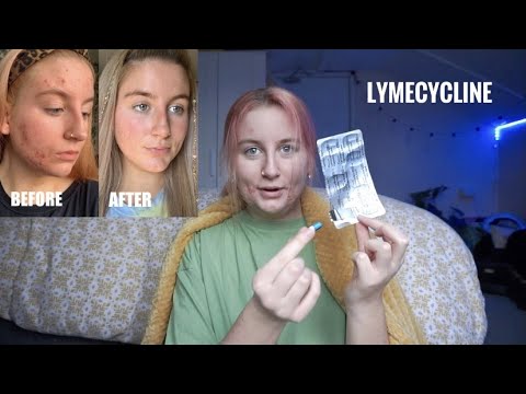 my acne journey | lymecycline