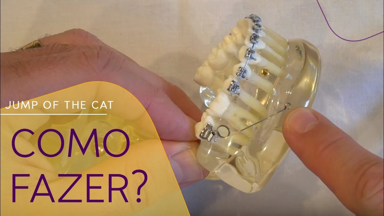 Cantilever de Verticalização de Molar