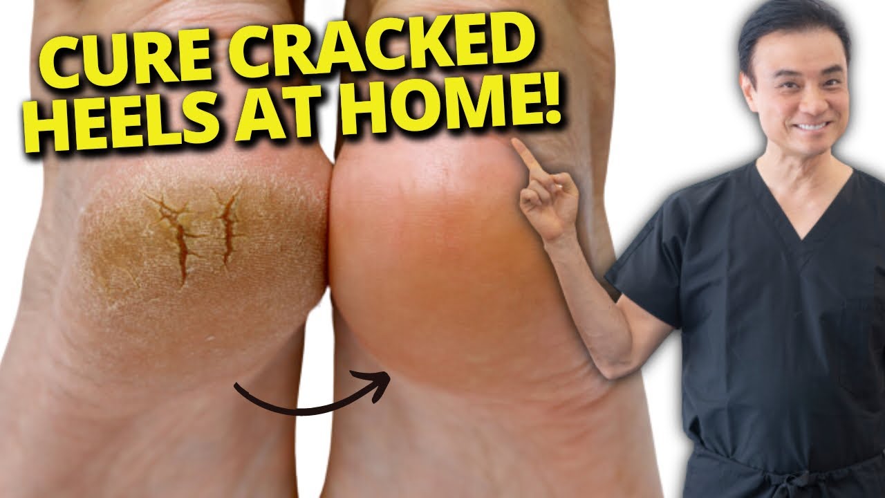 These 5 home remedies for cracked heels are a saviour. Try them right away!