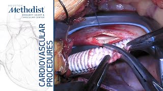 Aorta To Right Carotid Bypass (A. Lumsden, MD, M. Ramchandani, MD, E. Andraos, MD, M. Zubair, MD) Aorta To Right Carotid Bypass (A. Lumsden, MD, M. Ramchandani, MD, E. Andraos, MD, M. Zubair, MD)