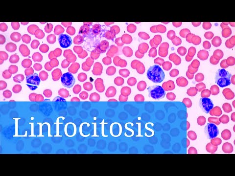 Vídeo: Linfocitosis: Causas, Síntomas Y Tratamiento