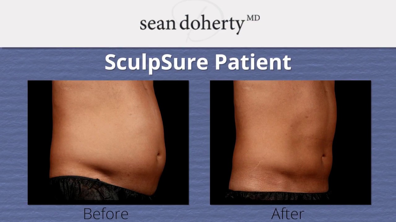 Melt Fat Away With SculpSure, No Surgery Required - YouTube