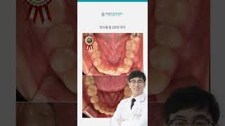 🦷타임교정치과 치아총생 20대 여자🦷 #강서구치과 #강서구교정치과 #발산역치과 #발산역교정치과