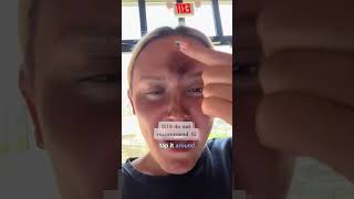 I Forgot To Take My Pimple Patch Off Before Spray Tan