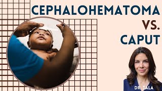 Caput Succedaneum Vs Cephalohematoma - Nicu Nuggets - Tala Talks Nicu