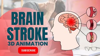 What Causes a Brain Stroke? | Brain Attack 3D Animation & Treatment