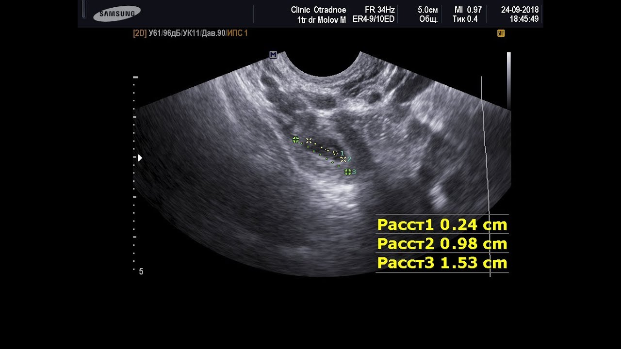 Трансвагинальное узи на ранних сроках беременности