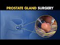 How Open Radical Prostatectomy Is Performed? | Prostate Cancer Treatment