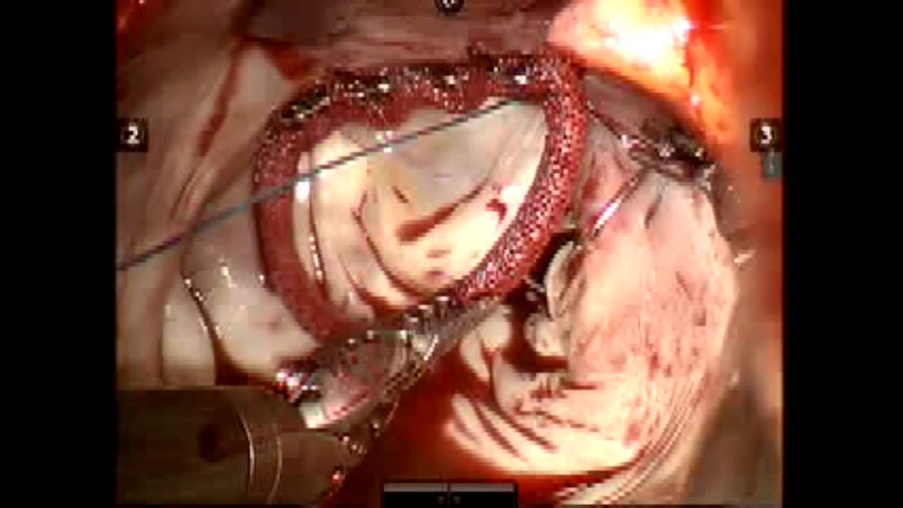 Robot Assisted Mitral Valve Repair With Annuloplasty By Charles