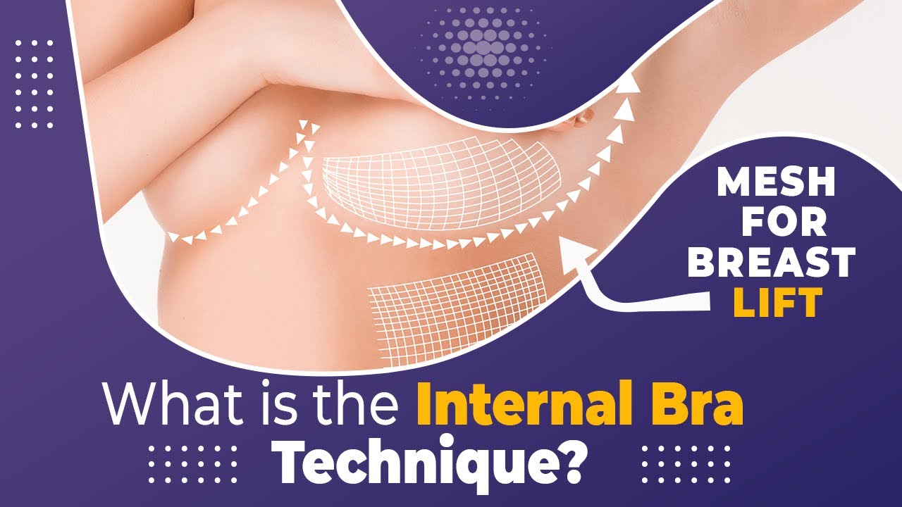 What is Internal Bra Lift Technique? Internal Bra Lift: More Durable Breast  Lift Technique in Delhi 