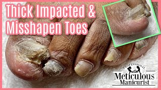 👣 A PEDICURE For TOE NAIL FUNGUS TRANSFORMATION - PART 2👣