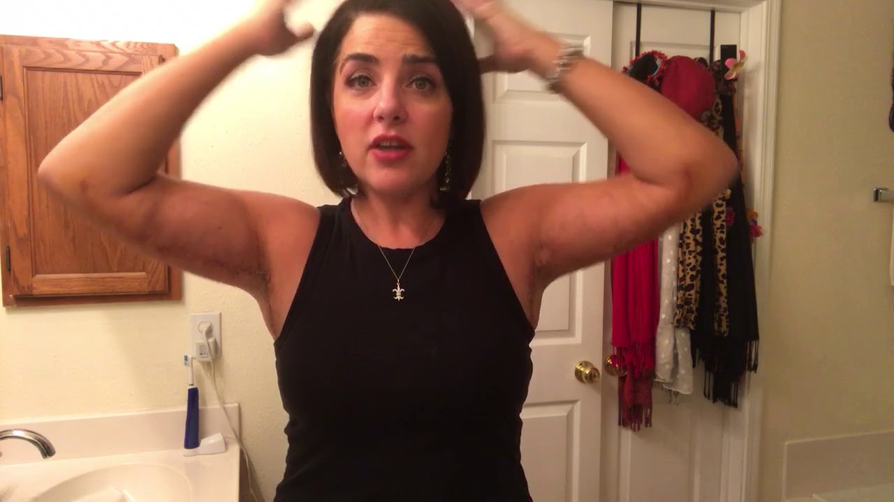 Brachioplasty 2 Week Update