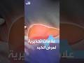 علامات تحذيرية لمرض الكبد