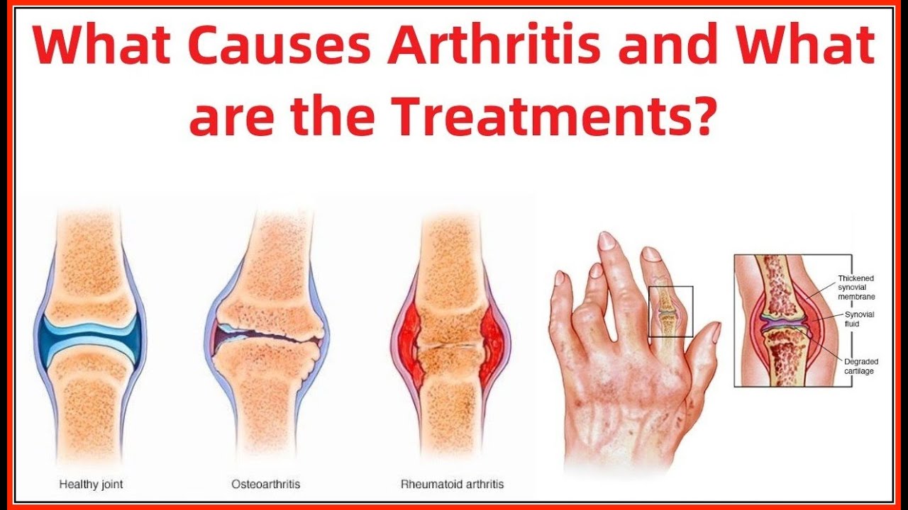 What Causes Arthritis and What are the Treatments? YouTube
