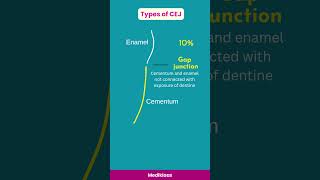 Cementoenamel junction types #cementum #enamel