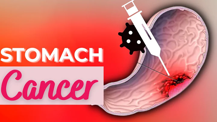 Stomach Cancer, Causes, Signs and Symptoms, Diagnosis and Treatment. - DayDayNews