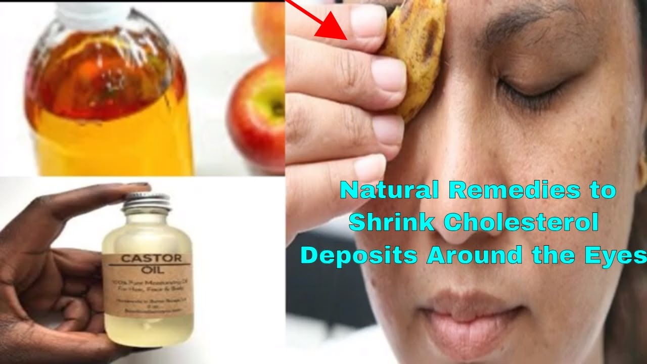 Natural Remedies to Shrink Cholesterol Deposits Around the Eyes! YouTube