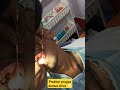 🔥 “Tooth Pain se Relief 😁 Lower 7 RCT Ongoing”#viralvideo #dentist #trendingnow
