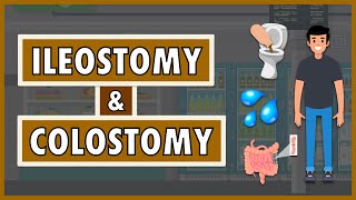 Ileostomy and Colostomy | Emphasis on Diet/Nutrition